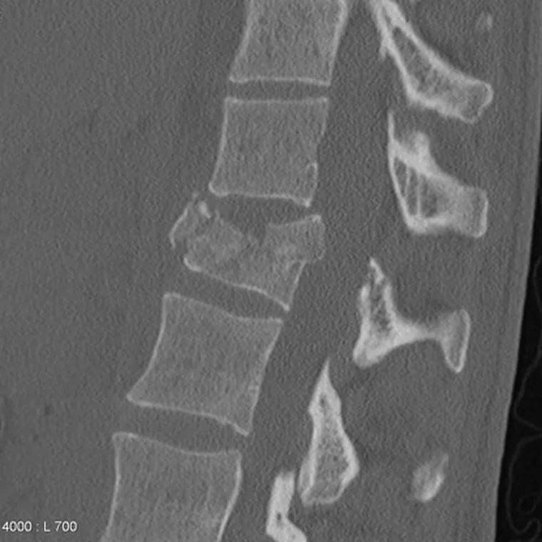 Tomografia com fratura vertebral